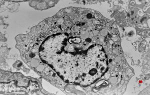 F, 2m. | surfactant deficiency- alveolar macrophage